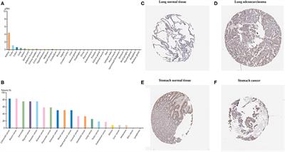 Comprehensive Analysis of the Expression, Relationship to Immune Infiltration and Prognosis of TIM-1 in Cancer